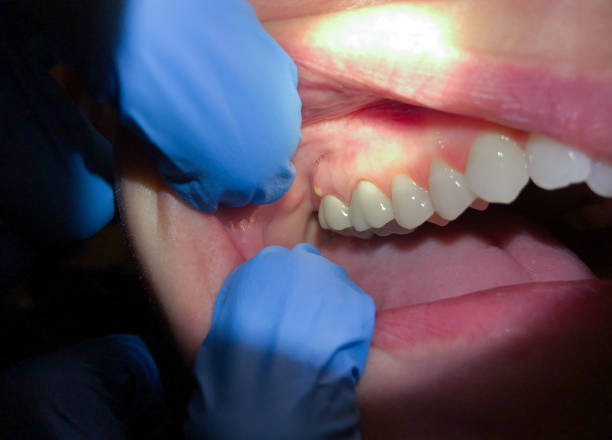 Best Emergency Treatment for Oral Infections in Evanston, IL